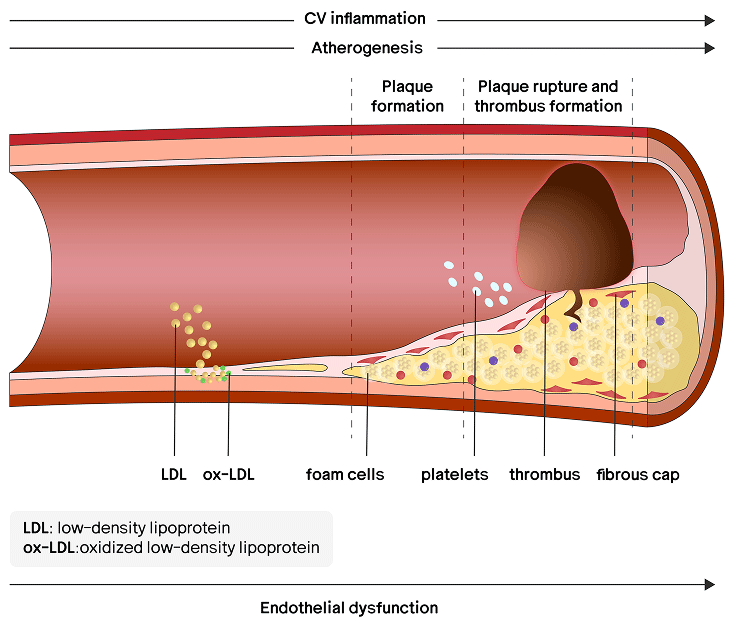 Diagram of blood vessel showing progression of cardiovascular inflammation and atherosclerotic disease